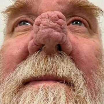 img-66 Drama omului elefant: Bărbatul cu rinofima de deformare nazală