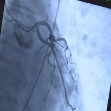 img-1177 Intervenție complicată la Institutul CC Iliescu