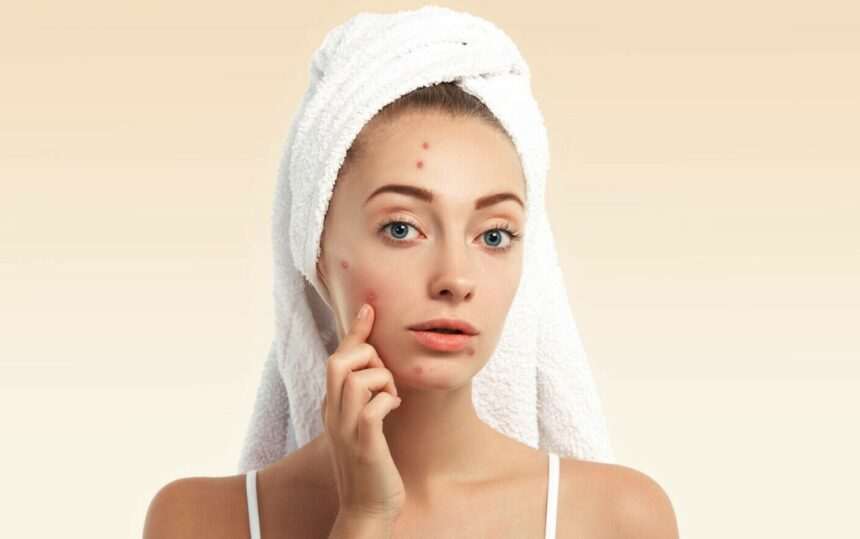 img-357 Substanță cancerigenă descoperită în produse împotriva acneei de la mărci cunoscute