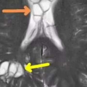 Descoperirea șocantă a unui bărbat după ce a consumat bacon
