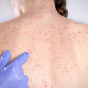 Epidemie de rujeolă în România: de la campioană la vaccinare la tragedii evitabile