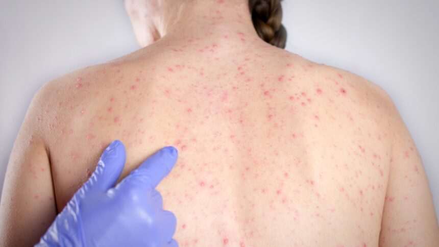 Epidemie de rujeolă în România: de la campioană la vaccinare la tragedii evitabile