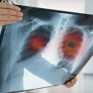 img-1571 Cancerul în rândul românilor sub 50 de ani: o problemă tot mai des întâlnită