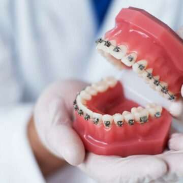 img-1619 Sfaturi pentru îngrijirea corectă a aparatului dentar