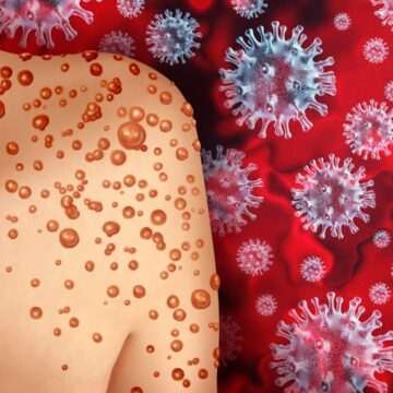 img-206 Situația alarmantă din Africa de Sud: Două persoane au murit din cauza mpox