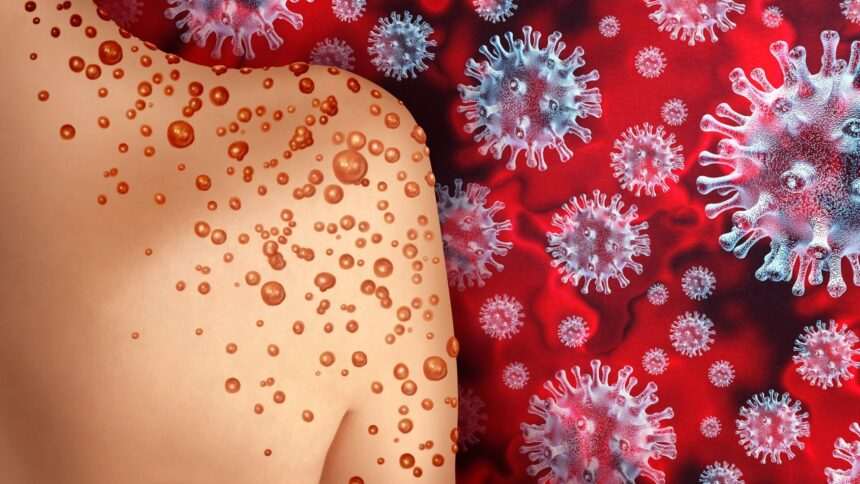 img-206 Situația alarmantă din Africa de Sud: Două persoane au murit din cauza mpox