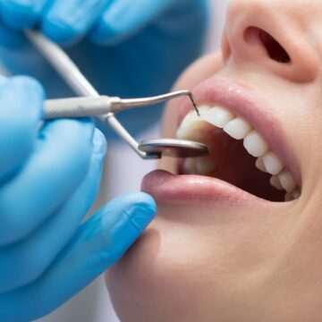 img-243 Reabilitarea orală și importanța fațetelor dentare