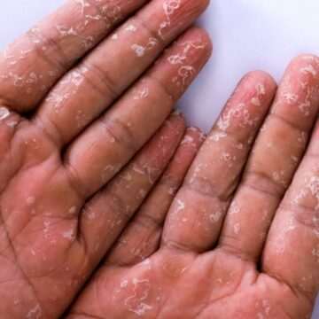 Epidemie mortală de sindromul șocului toxic streptococic în Japonia