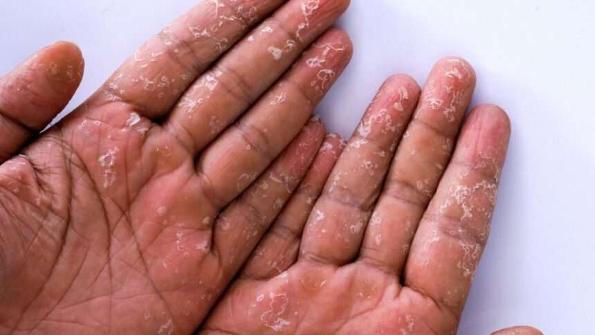 img-519 Epidemie mortală de sindromul șocului toxic streptococic în Japonia