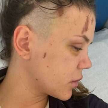 img-250 Diagnostic crunt pentru Emily Burghelea, după accidentul din Mauritius