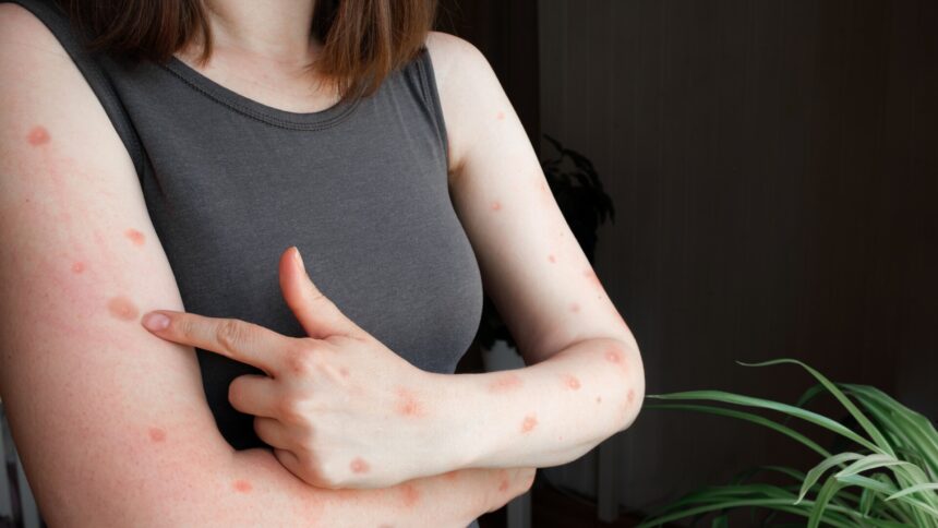 img Combaterea mpox: Oficial al OMS subliniază importanța acțiunii comune