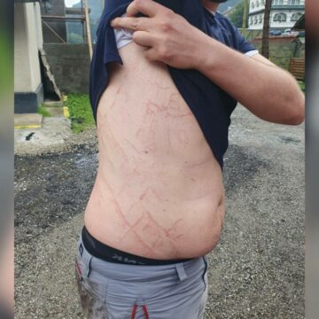 Avertismentul salvamontiștilor: Semnele lăsate pe corpul unui bărbat de un trăsnet care a lovit lângă el