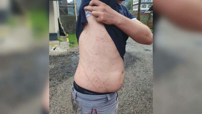 img Avertismentul salvamontiștilor: Semnele lăsate pe corpul unui bărbat de un trăsnet care a lovit lângă el