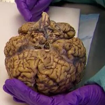 img Impactul fragmentelor de plastic asupra organismului uman