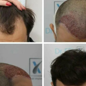 img Implantul de păr: Procedura, recuperarea și rezultate