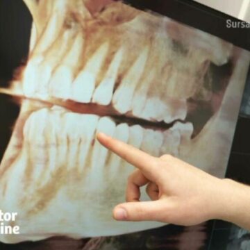 img De ce se recomandă extracția măselelor de minte, chiar dacă nu s-au cariat. Tind să dispară în evoluția noastră