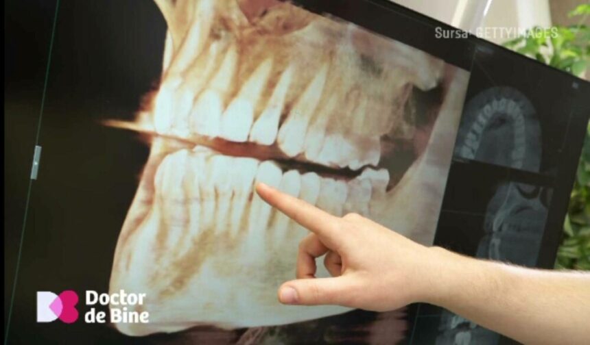 img De ce se recomandă extracția măselelor de minte, chiar dacă nu s-au cariat. Tind să dispară în evoluția noastră