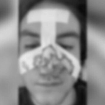 Scandalul adolescentilor din Botosani: elev olimpic desfigurat in bataie