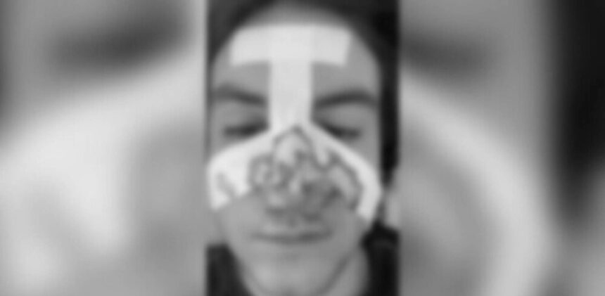 img Scandalul adolescentilor din Botosani: elev olimpic desfigurat in bataie