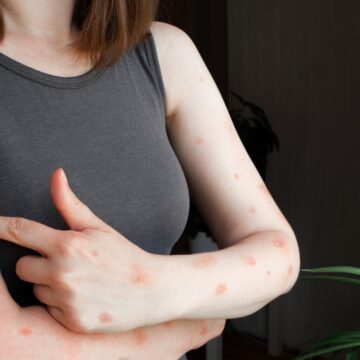 img SUA au confirmat primul caz de infectare cu noua tulpină mpox, în California