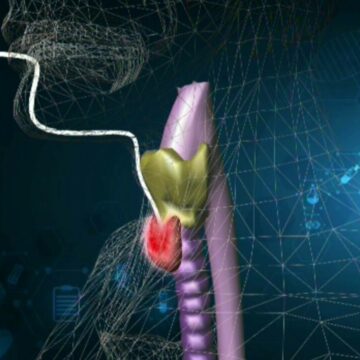 Premieră la Spitalul Elias: Operație de scoatere a tiroidei fără cicatrice vizibilă