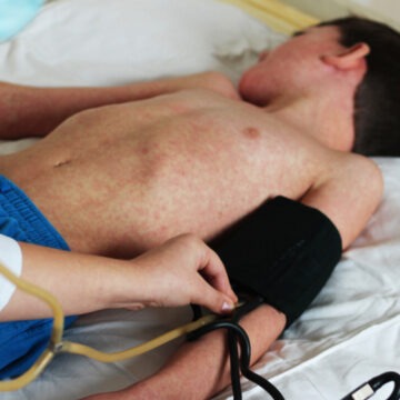 img Epidemia de rujeolă din România și impactul refuzului vaccinării