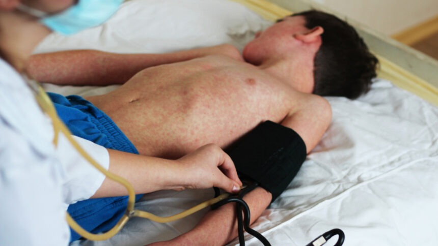 Epidemia de rujeolă din România și impactul refuzului vaccinării
